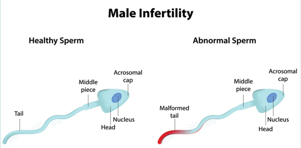 Male Infertility Treatment In Chennai