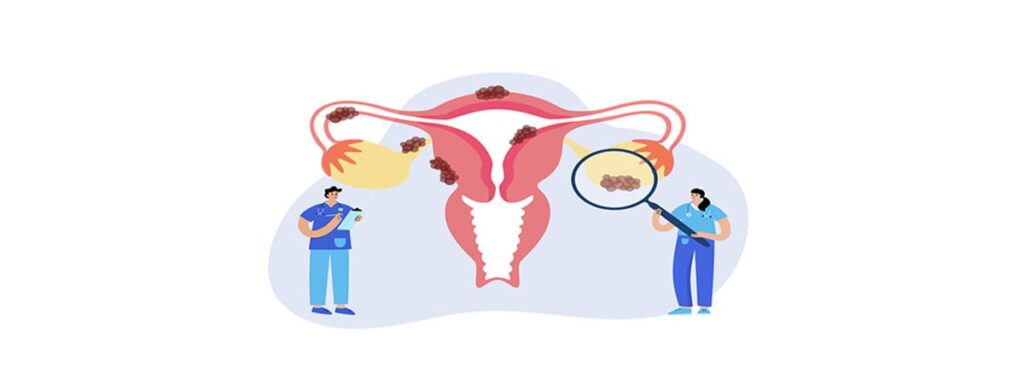 AYURVEDIC PCOS TREATMENT