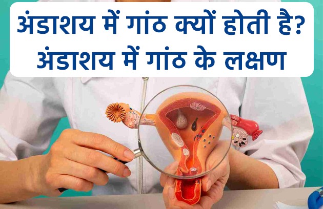 अंडाशय में गांठ क्यों होती है? अंडाशय में गांठ के लक्षण