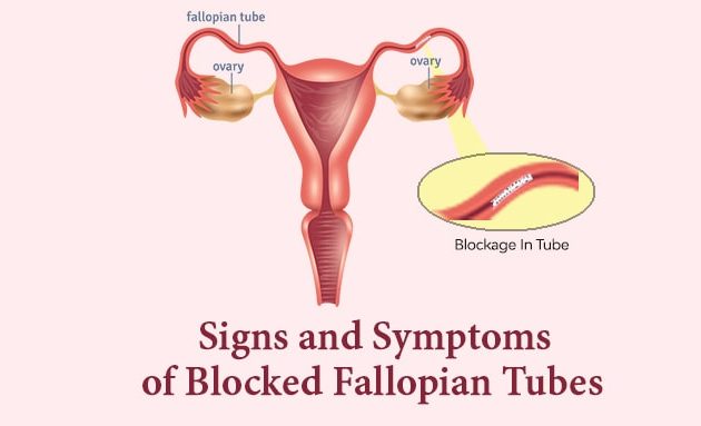 sign and symptoms of fallopian tube