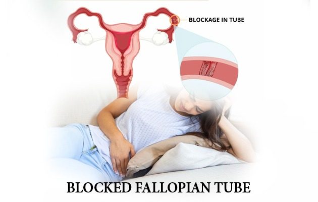 fallopian tube, block fallopian tube