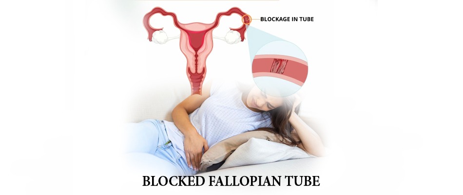 fallopian tube, block fallopian tube