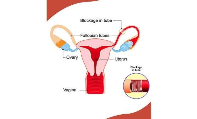 Blocked Fallopian Tubes Treatment, Natural Treatment for Tubal Blockage