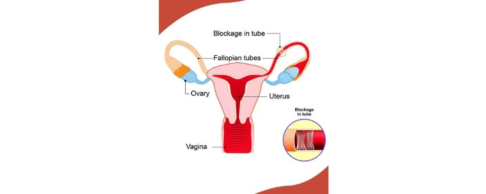 Blocked Fallopian Tubes Treatment, Natural Treatment for Tubal Blockage