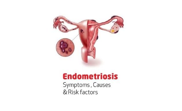 Endometriosis: risk factors, prevention, causes and Ayurvedic treatment