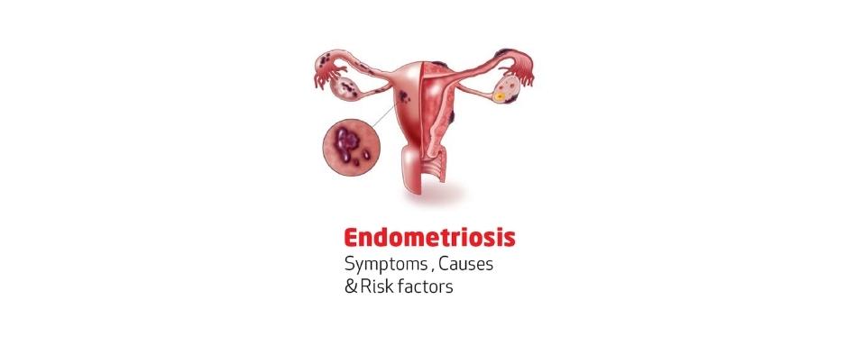 Endometriosis: risk factors, prevention, causes and Ayurvedic treatment