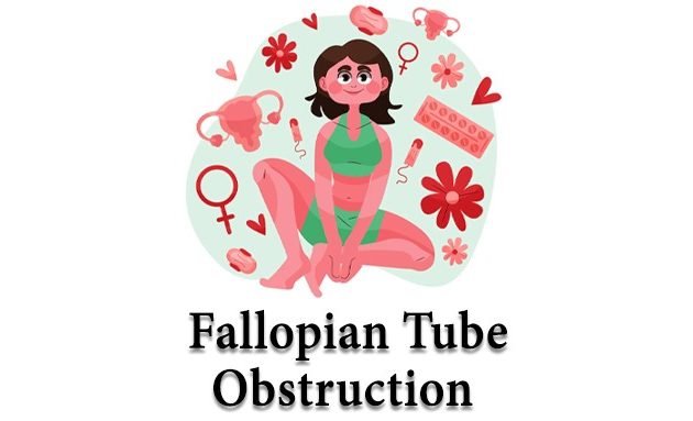 Fallopian tube Dr in Delhi, Fallopian tube obstruction. tubal factor infertility
