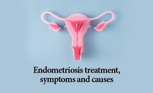 endometriosis treatment, endometriosis symptoms and causes