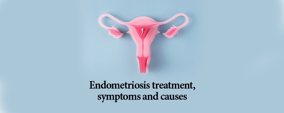 endometriosis treatment, endometriosis symptoms and causes