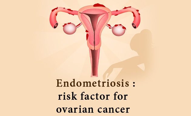Endometriosis: queries including risk factor for ovarian cancer