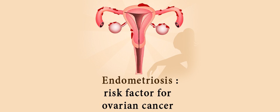Endometriosis: queries including risk factor for ovarian cancer