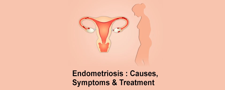 Endometriosis causes, treatment