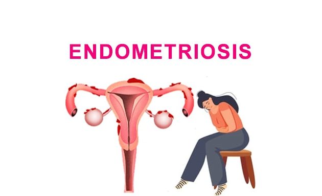 endometriosis treatment