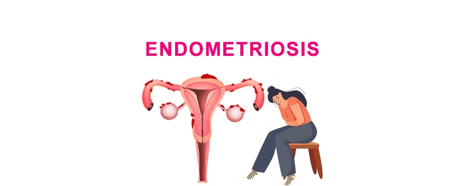 endometriosis treatment