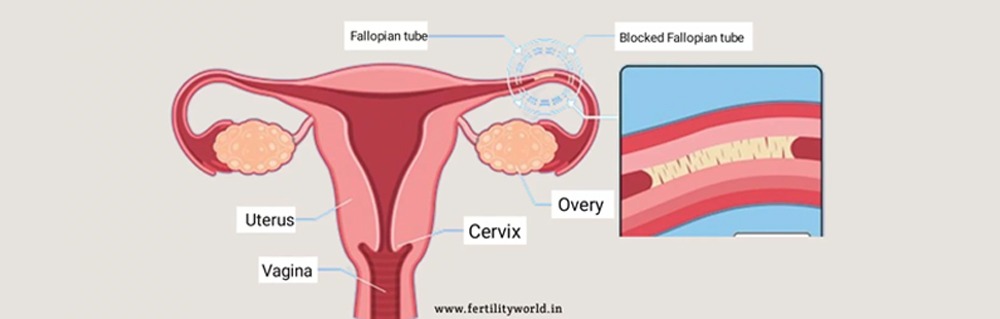 blockage of fallopian tubes treatment
