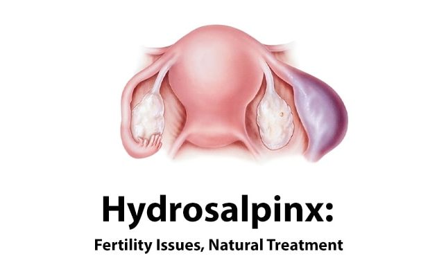 hydrosalpinx, hydrosalpinx fertility issues and natural treatment
