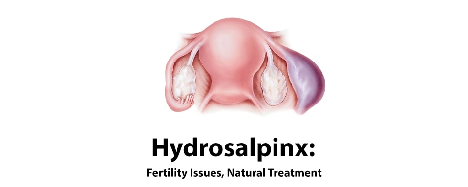 hydrosalpinx, hydrosalpinx fertility issues and natural treatment