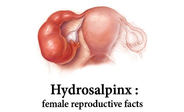 hydrosalpinx ayurvedic treatment, hydrosalpinx causes and symptoms