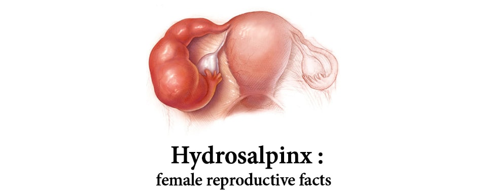 hydrosalpinx ayurvedic treatment, hydrosalpinx causes and symptoms