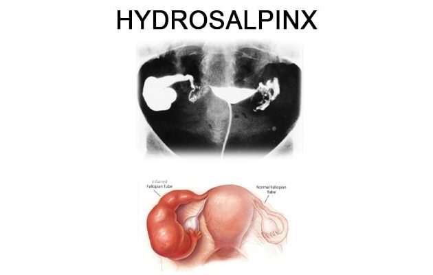 hydrosalpinx, ayurvedic treatment of hydrosalpinx, hydrosalpinx ayurvedic treatment