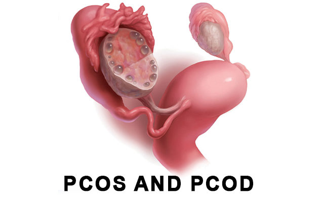 pcos and pcod, treatment for pcos and pcod