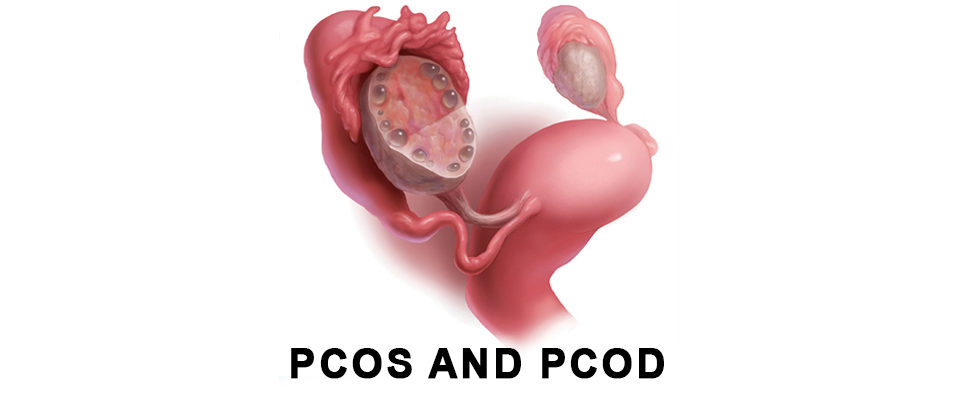 pcos and pcod, treatment for pcos and pcod