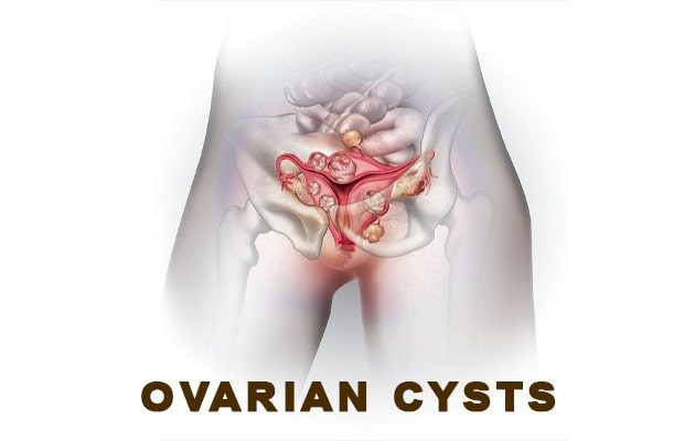 Ovarian cysts: symptoms and causes – Dr Chanchal Sharma