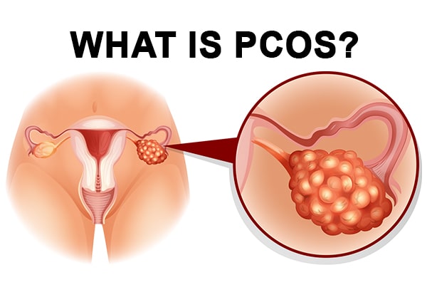 what is pcos, Polycystic ovary syndrome