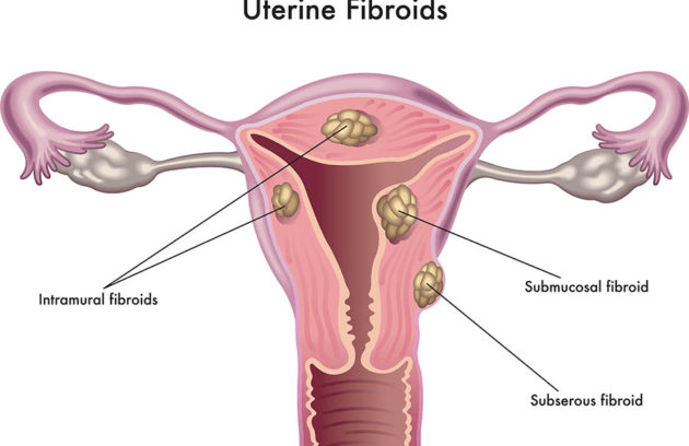 Uterine fibroids – diagnosis and treatment – Dr Chanchal Sharma