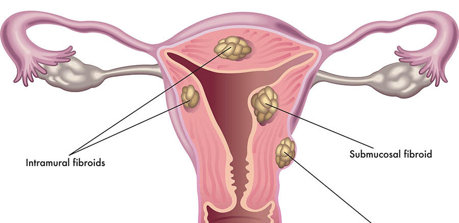 Uterine fibroids – diagnosis and treatment – Dr Chanchal Sharma