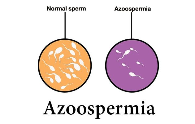 Azoospermia Treatment, natural treatment for azoospermia, low sperm count treatment
