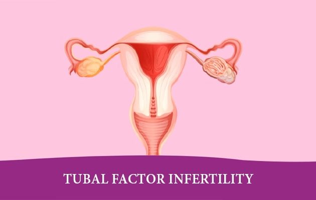What is a tubal blockage?