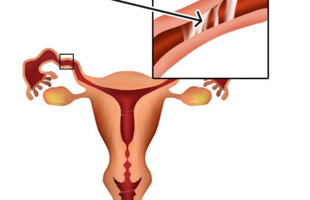 Tubal Blockage Factor (Fallopian Tubes) Infertility – Dr Chanchal Sharma