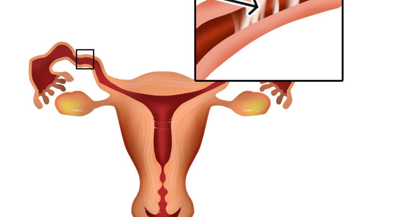 Tubal Blockage Factor (Fallopian Tubes) Infertility – Dr Chanchal Sharma