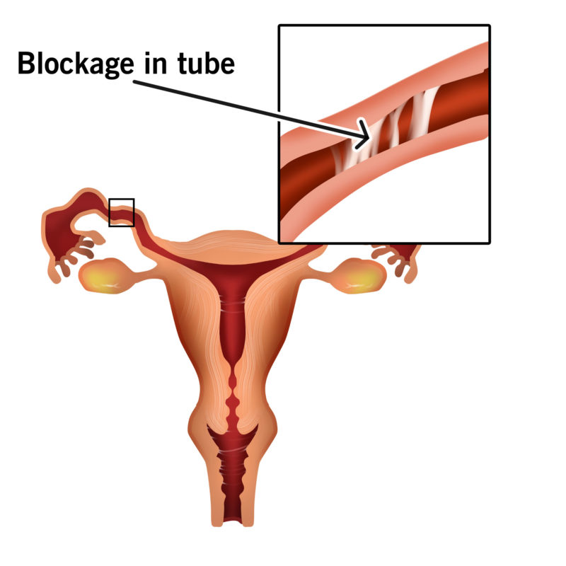 Tubal Blockage Factor (Fallopian Tubes) Infertility – Dr Chanchal Sharma
