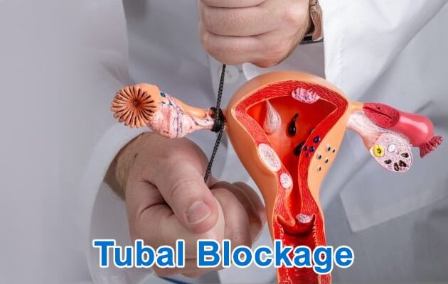 About blocked fallopian tubes | Fallopian tube treatment doctor