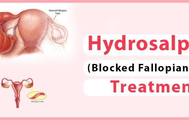 Hydrosalpinx Treatment (Blocked Fallopian Tube): Causes, Symptoms & Diagnosis