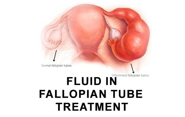 Fluid in Fallopian Tube Treatment