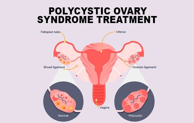 Polycystic Ovary Syndrome Treatment