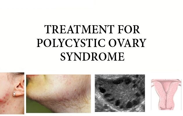Treatment for PCOS