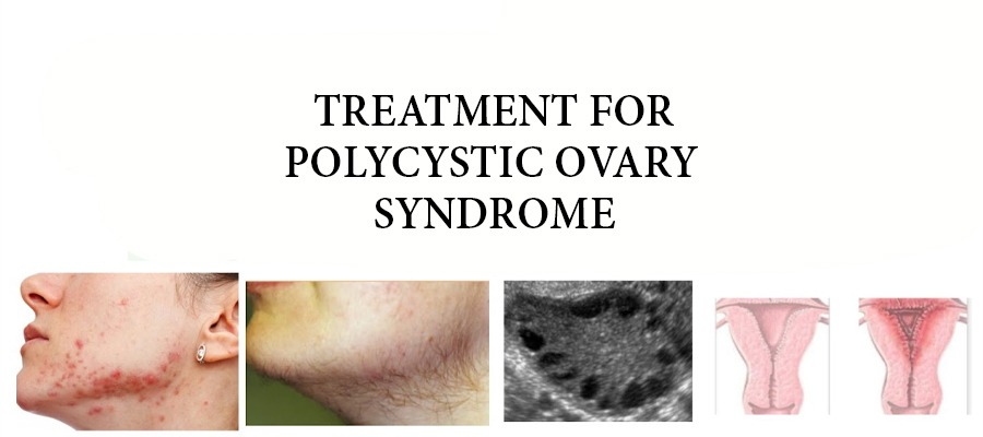 Treatment for PCOS