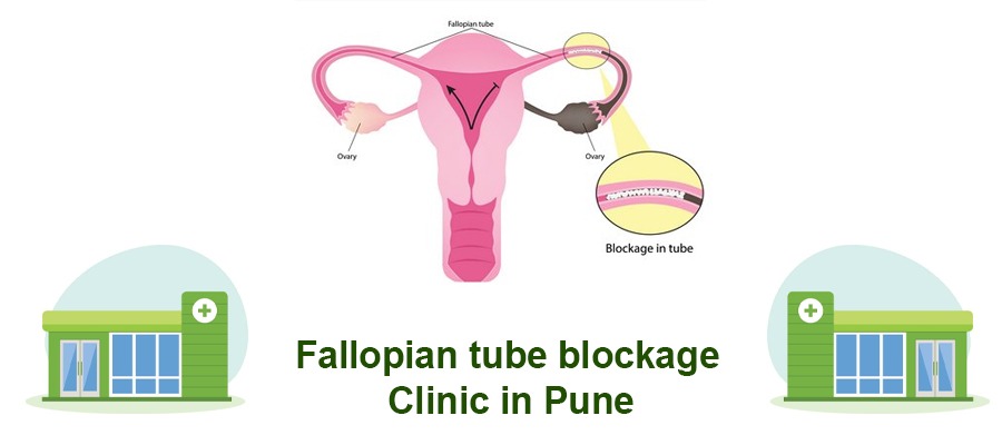 Fallopian Tube Blockage Clinic in Pune