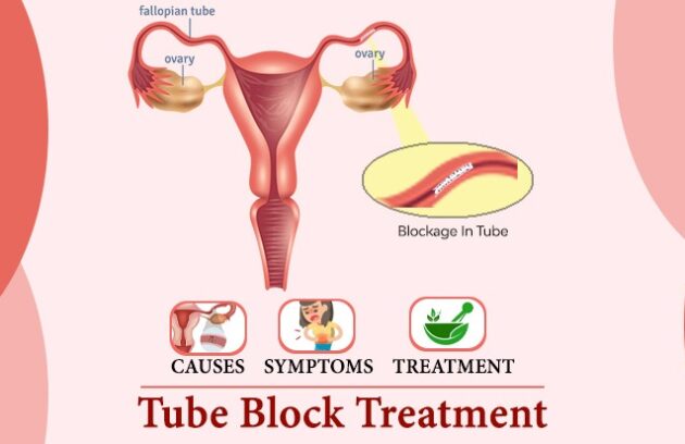 tube block treatment, fallopian tube blockage