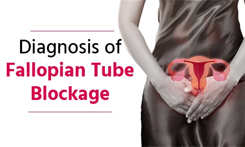 Diagnosis of Fallopian Tube Blockage Diagnosis of Fallopian Tube Blockage