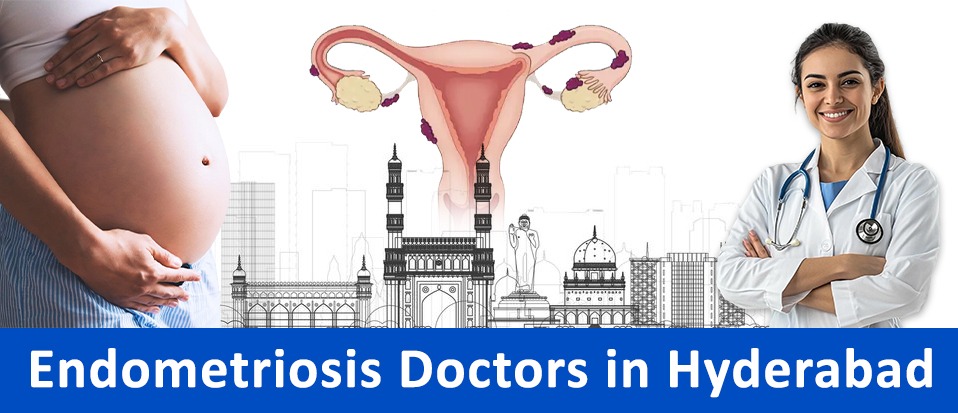Find the Best Endometriosis Doctors in Hyderabad 2025