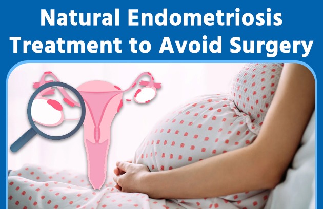 Natural Endometriosis Treatment to Avoid Surgery
