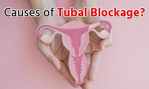 causes of Tubal Blockage